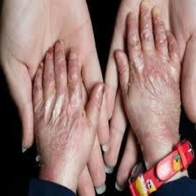 بال‌های زخمی پروانه‌های همدان؛ درد بیماری و هزینه‌های سنگین درمان